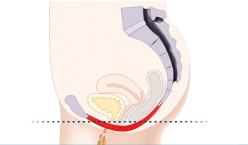Incontinence urinaire illustrée à l'aide d'un schéma des muscles du plancher pelvien