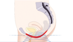 Schéma du traitement EMSELLA qui agit sur les muscles du plancher pelvien