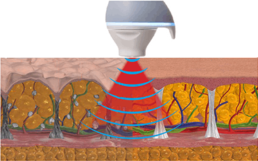 EMTONE cellulite avant après
